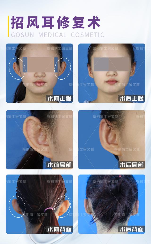 【案例】女生有一双招风耳是什么体验?为了摆脱招风耳