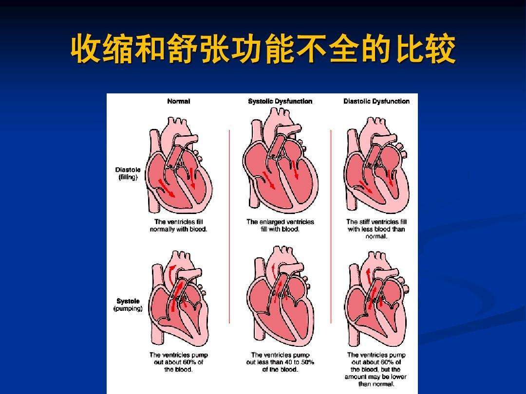 舒张性心力衰竭是由心室主动舒张功能障碍或顺应性减退,即充盈障碍所