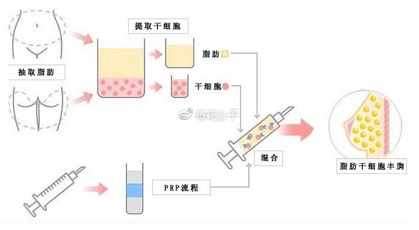 自体脂肪丰胸干货