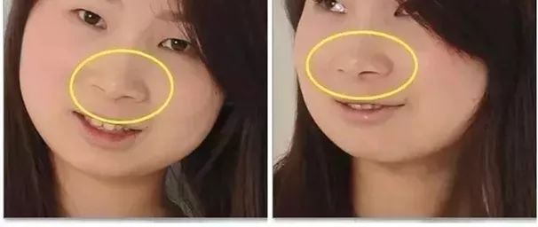 辟谣|鼻翼宽大只能切如何正确缩鼻翼