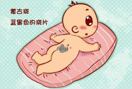 胎记三:蒙古斑太田痣也是经常现在宝宝身上的,它的颜色多为青,清灰,褐