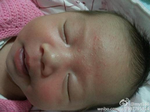 我家宝宝长疹子四天了,晚上哭闹很厉害,想请教下