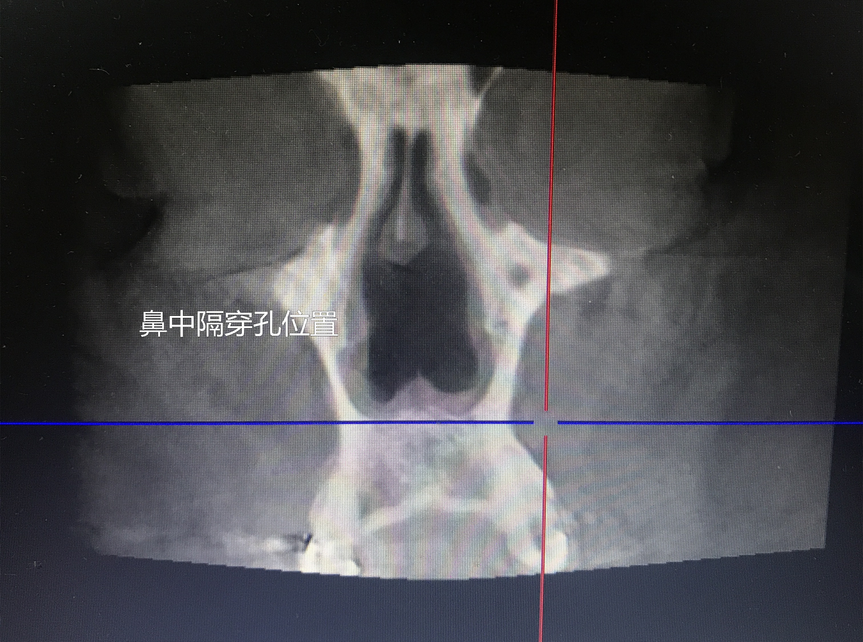 记鼻中隔穿孔患者的抑郁状态