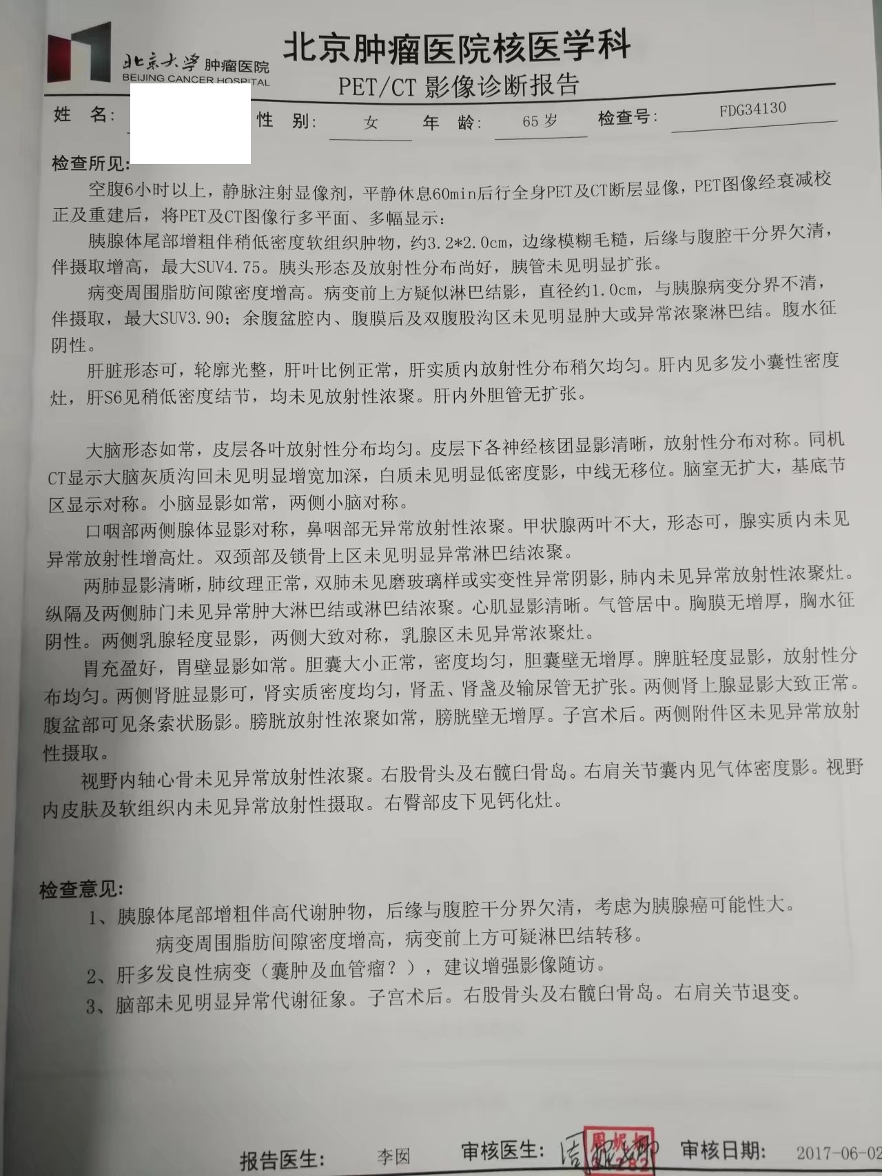 胰腺癌海扶治疗病历分享