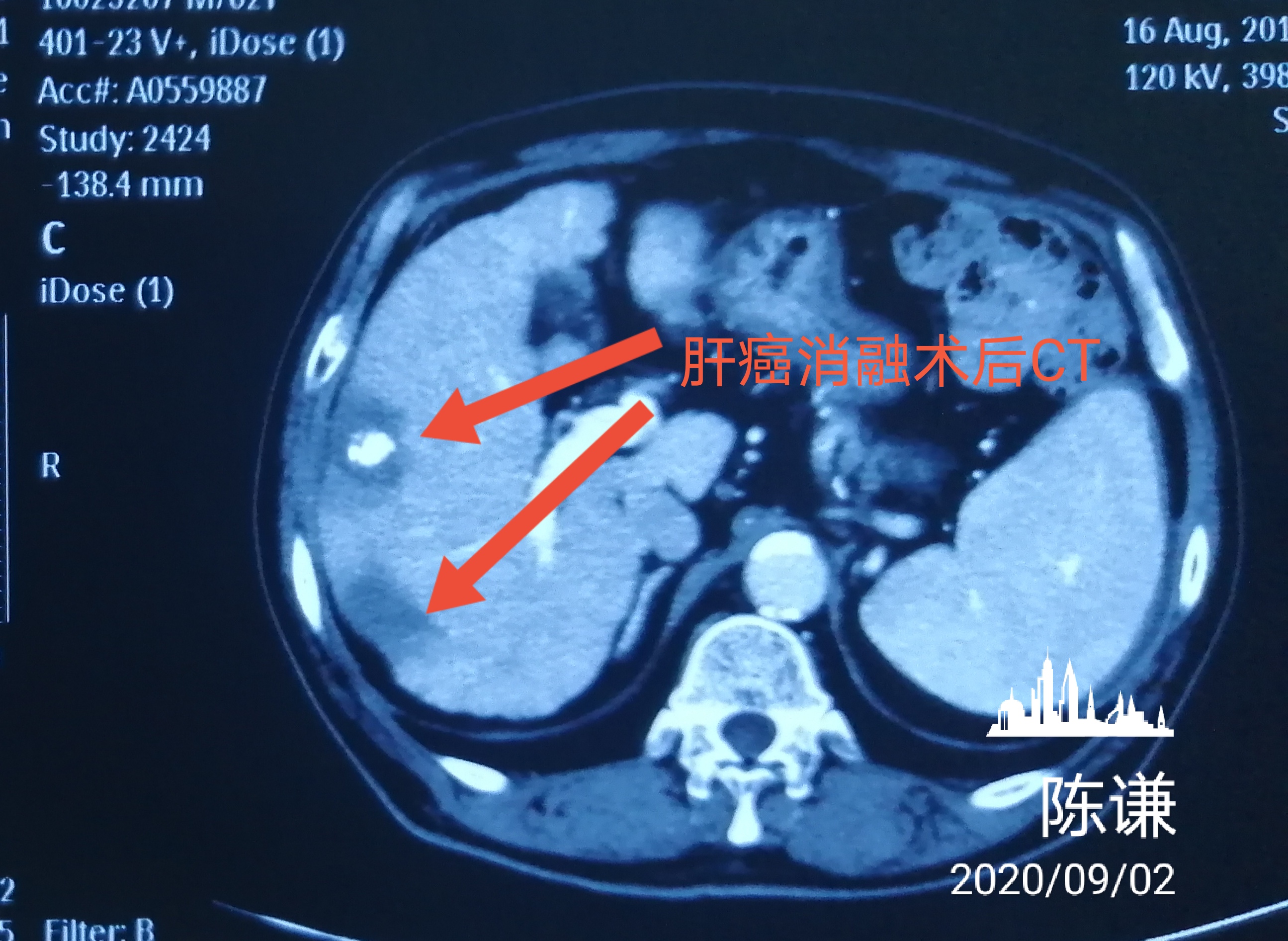 这是一个肝癌消融手术后复查的ct图像.
