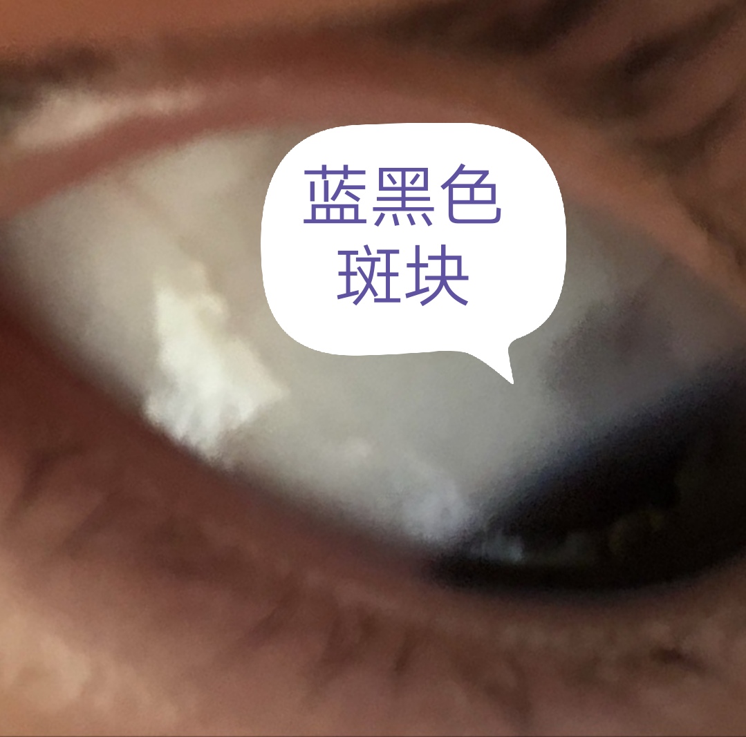 白眼珠上的黑点