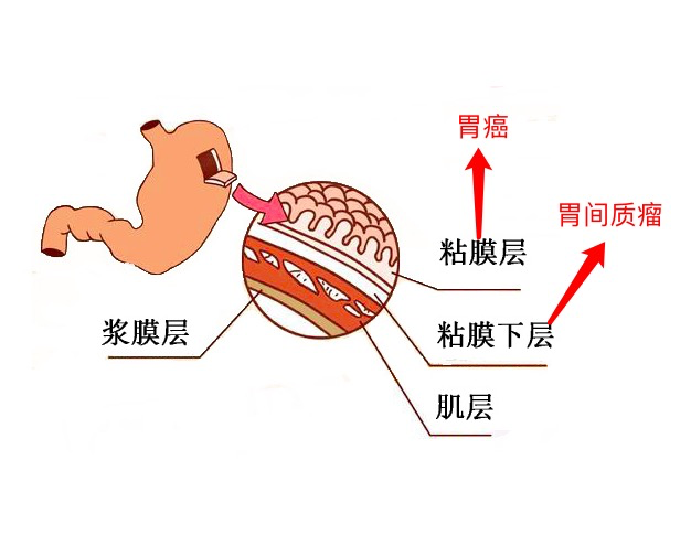 关于胃间质瘤的那二三事儿