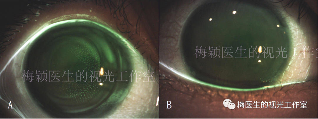 镜片粘附角膜,没有泪液交换,摘镜后角膜上出现了明显的气泡压痕和镜片