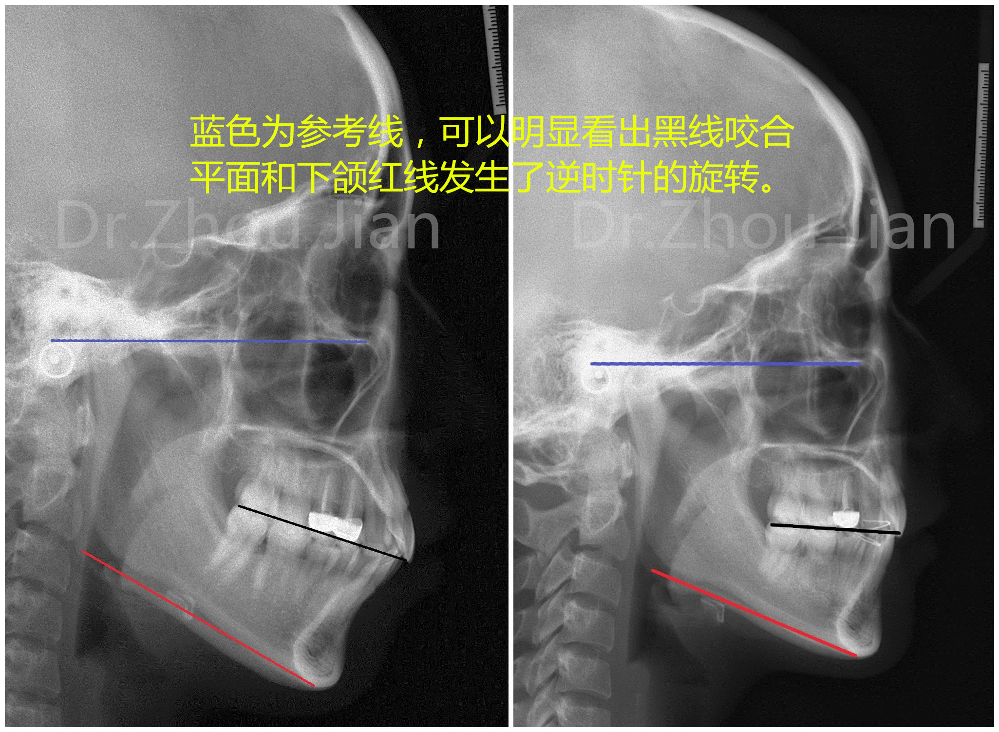 一下x光片,见证奇迹的时刻,下颌发生的逆时针旋转,让你的下巴"长"出来