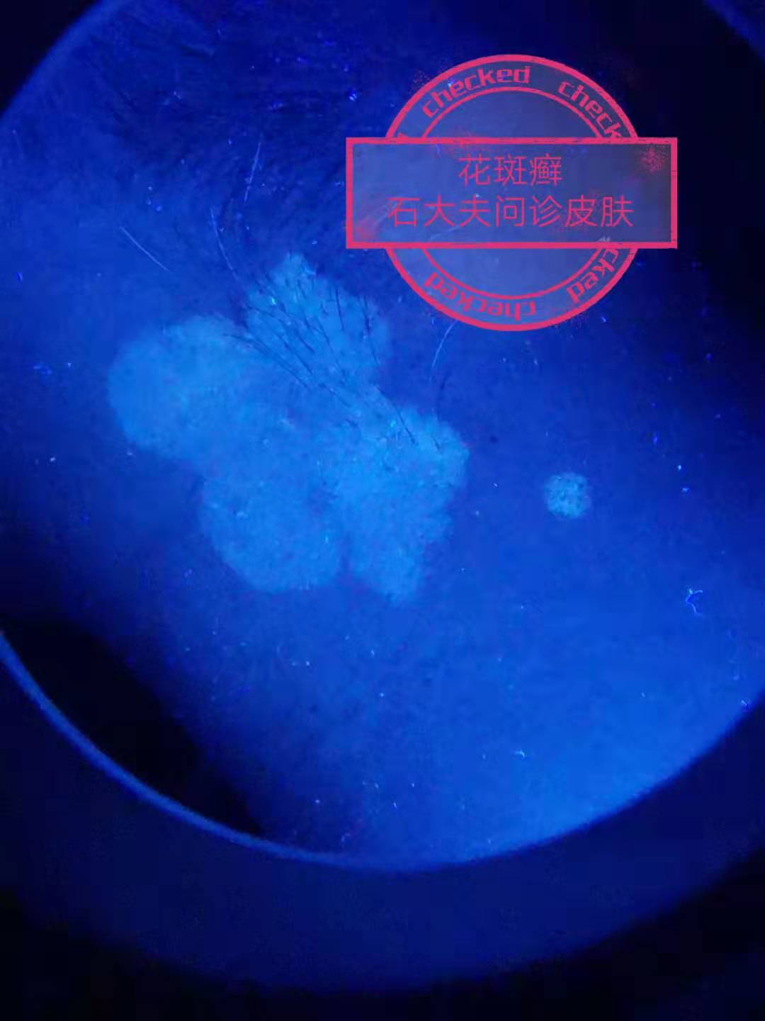 伍德氏灯照猫藓尿癣真菌手电筒紫外线荧光剂紫光验钞灯专用-阿里巴巴