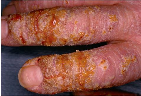 水痘样疹)是一种发生在ad受累皮肤上的快速播散性单纯疱疹病毒感染