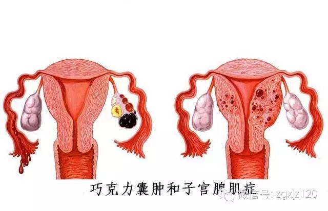 子宫腺肌症合并巧囊不治,癌变几率会变大!