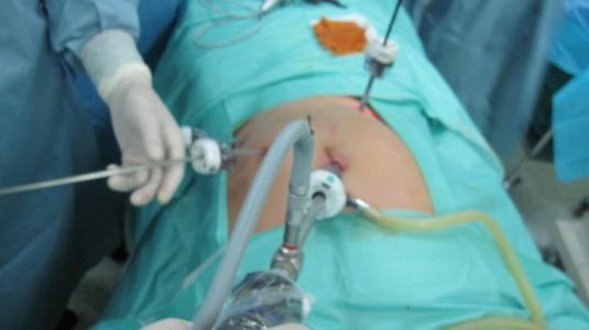 腹腔镜阑尾切除术