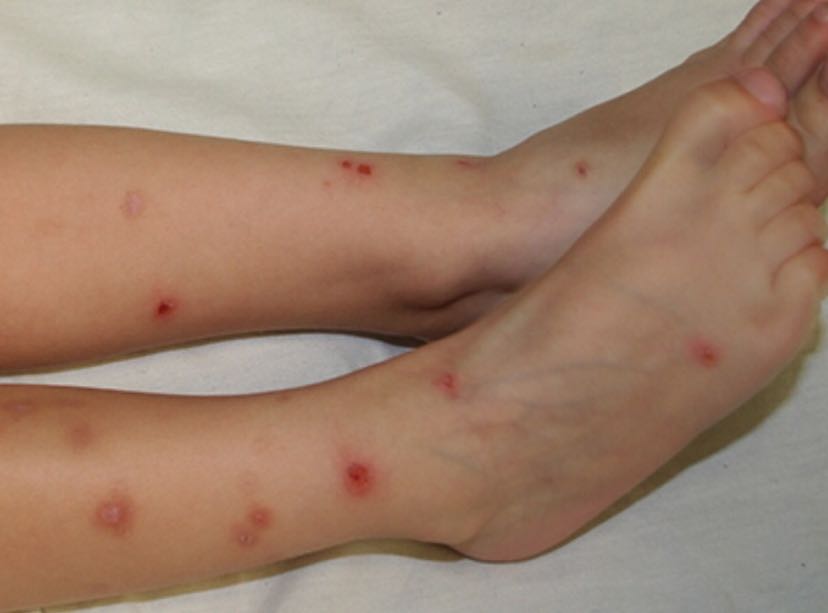 图片1   小片散在分布的水肿性红斑,中央可见突出皮肤表面的红色丘疹