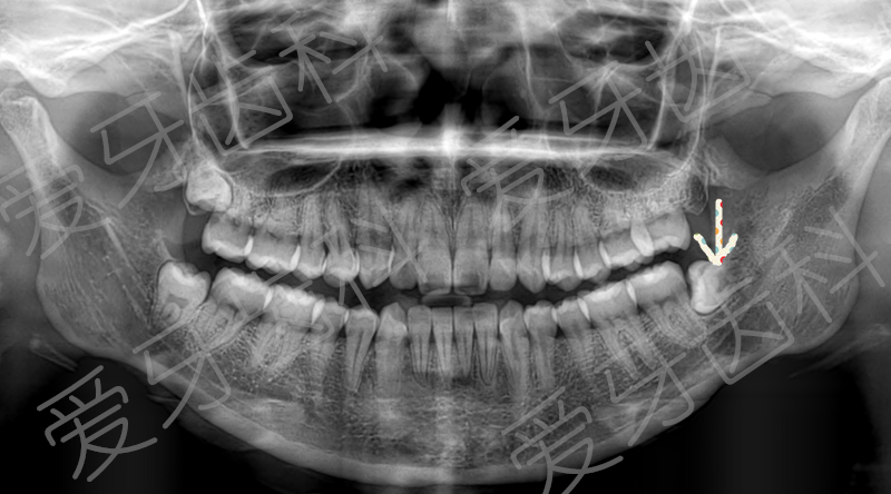 阻生智齿 这类智齿通常歪斜生长,有的牙齿完全在牙槽骨内横着生长