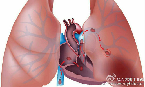 躺着也会中枪:隐蔽杀手肺栓塞