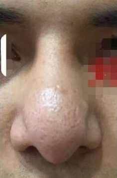 鼻头,鼻翼太大影响整体美观,怎么解决?请看此文