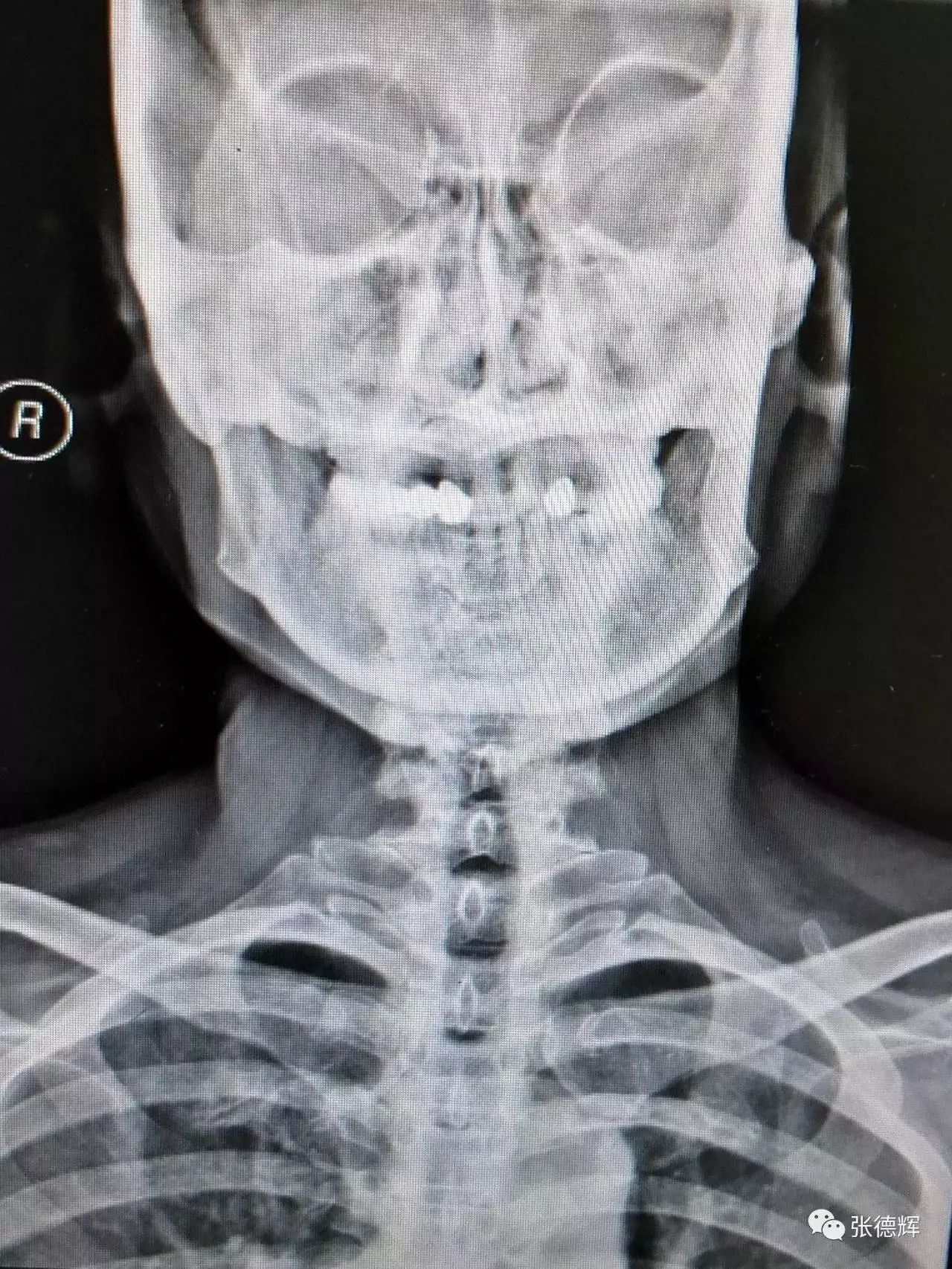 颈椎mri矢状位:颈4-5大块脱出,脊髓受压严重;伴有颅底凹陷畸形 颈椎