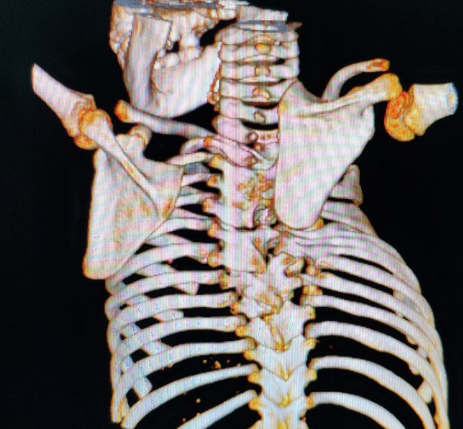将该疾病分为3型Ⅰ型 肋骨缺如伴脊柱侧凸Ⅱ型,肋骨融合伴脊柱侧凸
