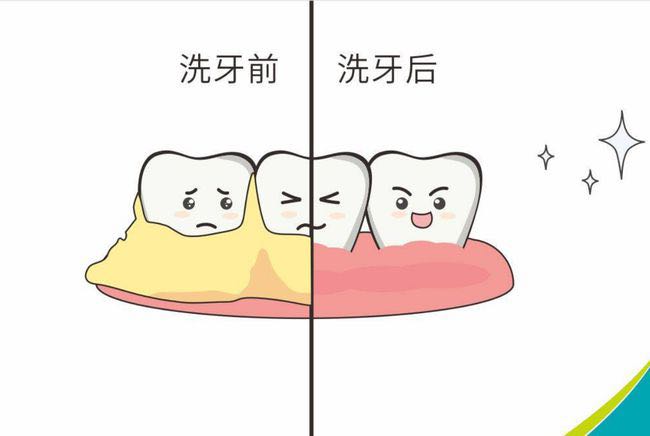 洗牙会导致牙龈出血吗?