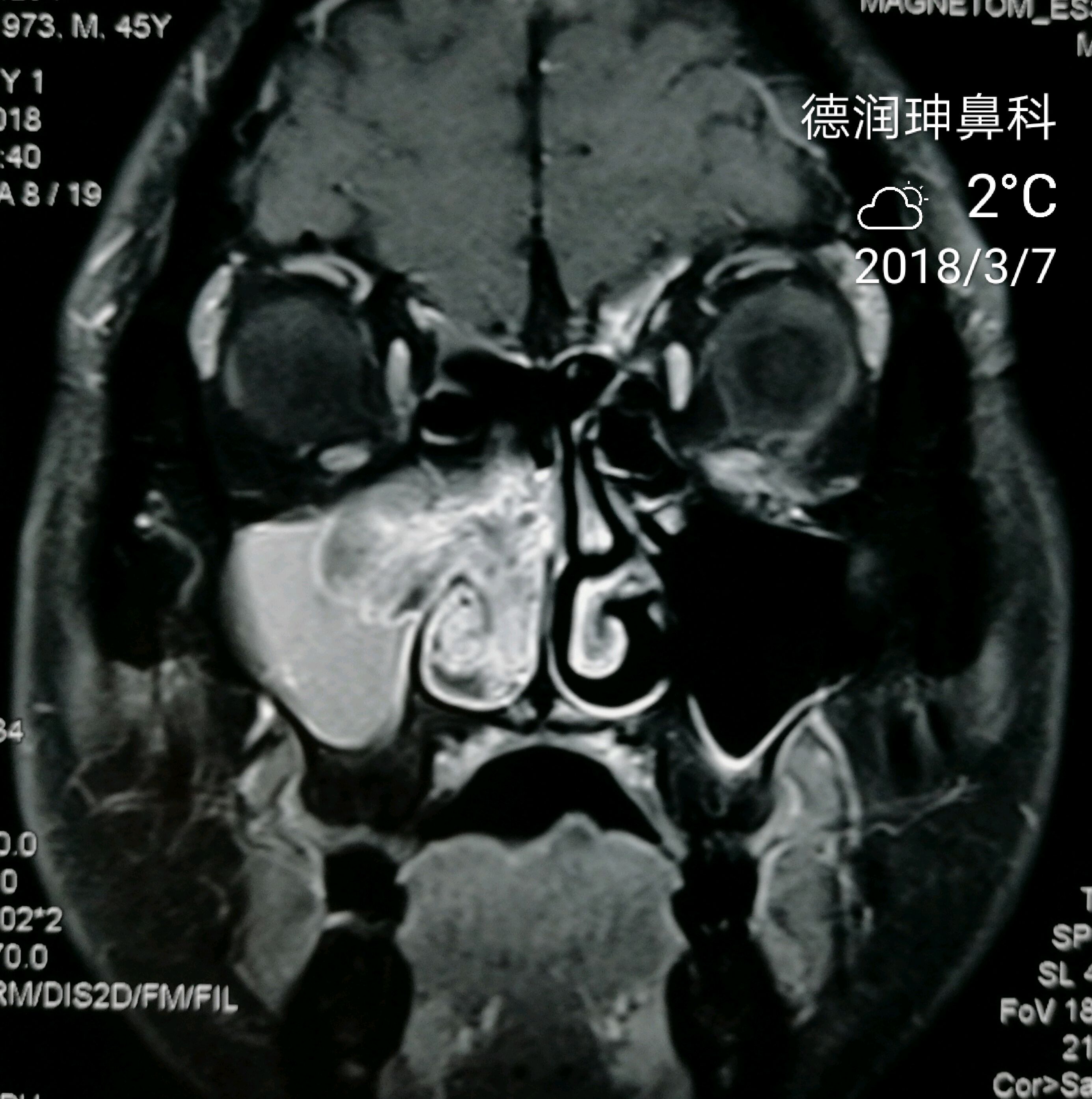 内翻性乳头状瘤一例_鼻科医生王先忠_新浪博客