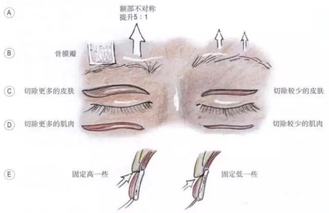 眉不对称和(或)单侧眼睑下垂(或退缩)是导致大多数眼睑不对称的原因.