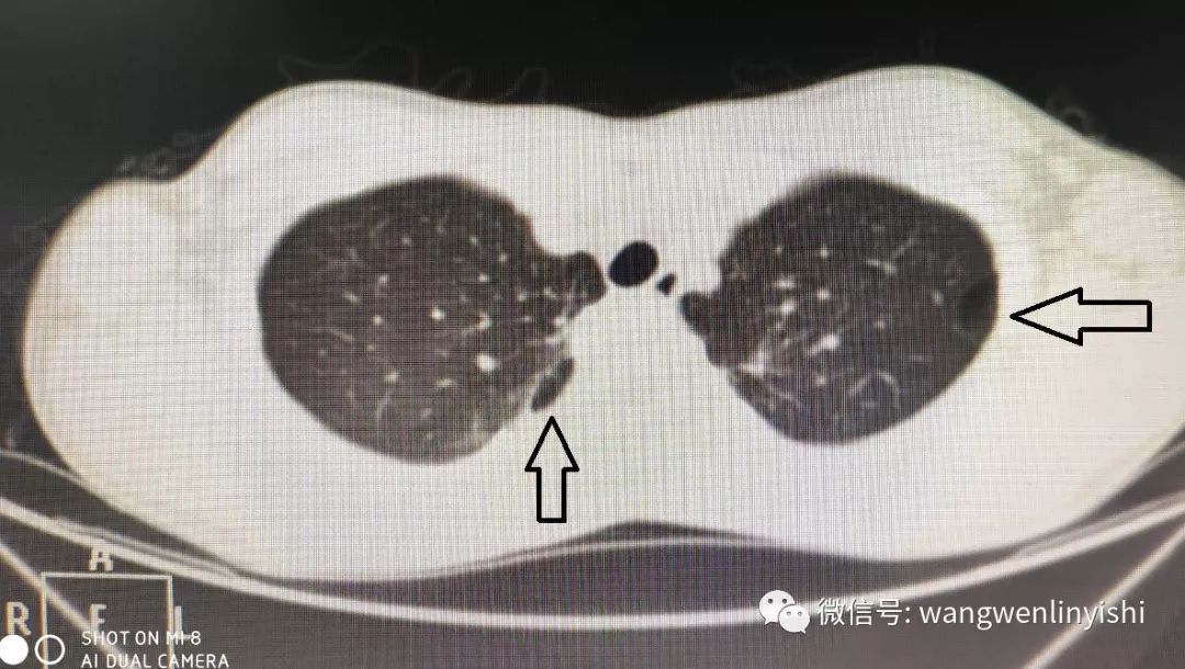 图4,术前ct,右上肺1个肺大泡(显示左侧第3个肺大泡.
