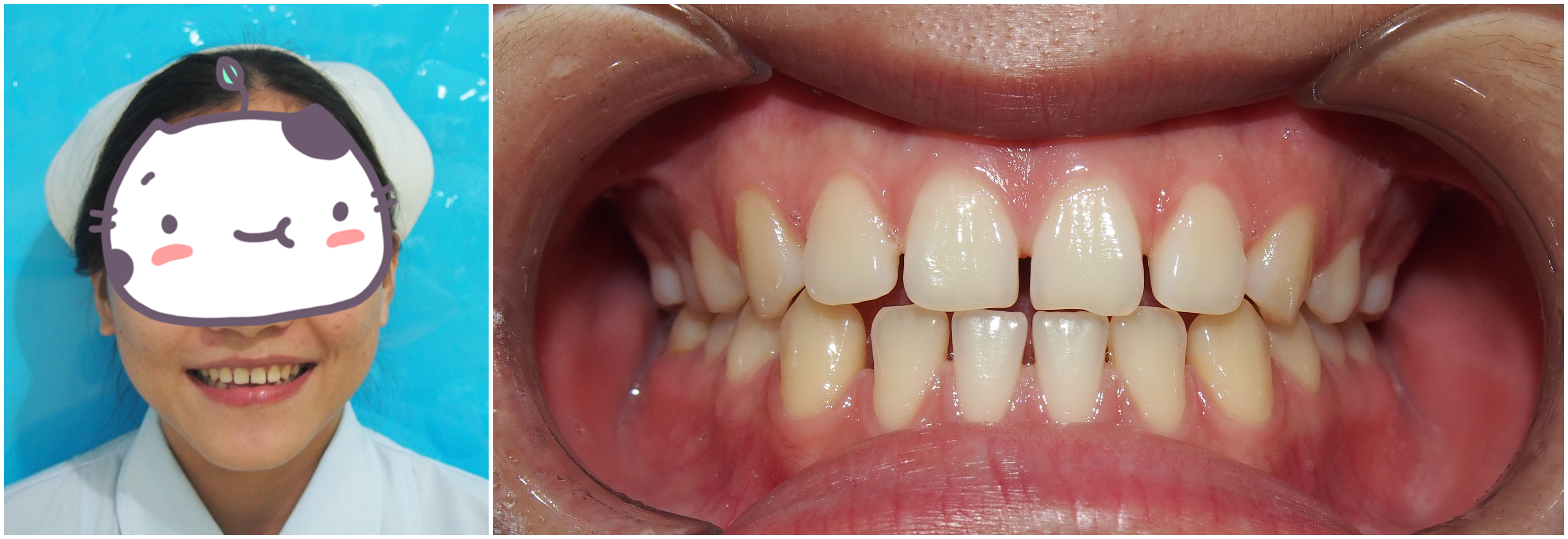矫治之前牙齿情况▼牙列稀疏