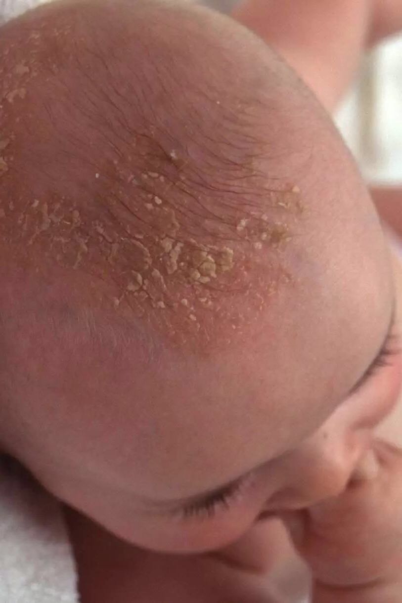 图片1  宝宝头皮发红,红斑表面可见大小不一的片状油腻黄色痂皮.