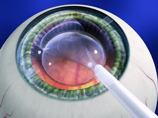 建议:不宜盲目扩大眼内屈光手术的适应证范围