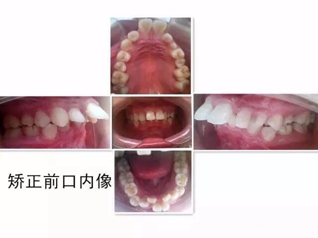 牙齿矫正中的扩弓会不会让脸变大?