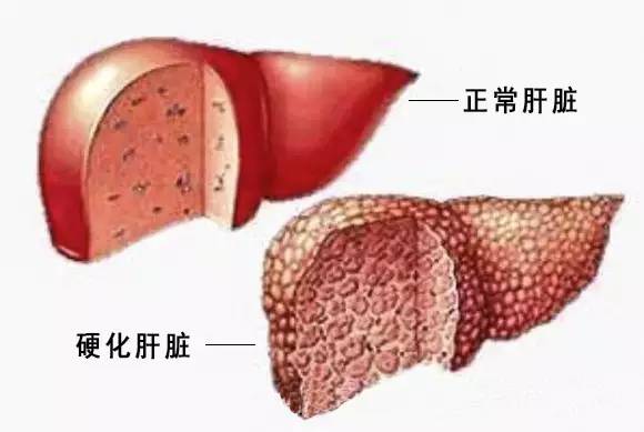 济南协和肝病医院骗 济南中医肝病医院_上海肝病医院上海华东肝病诊疗基地_肝病征兆