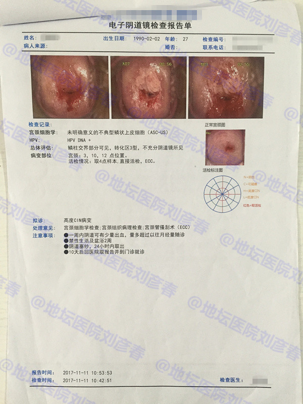 27岁女性宫颈cin3级病变并累及腺体