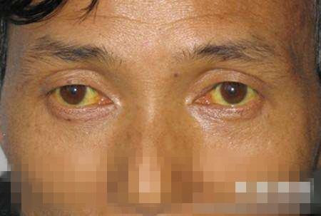 肝癌早期常被当成胃病,出现这4个症状要警惕
