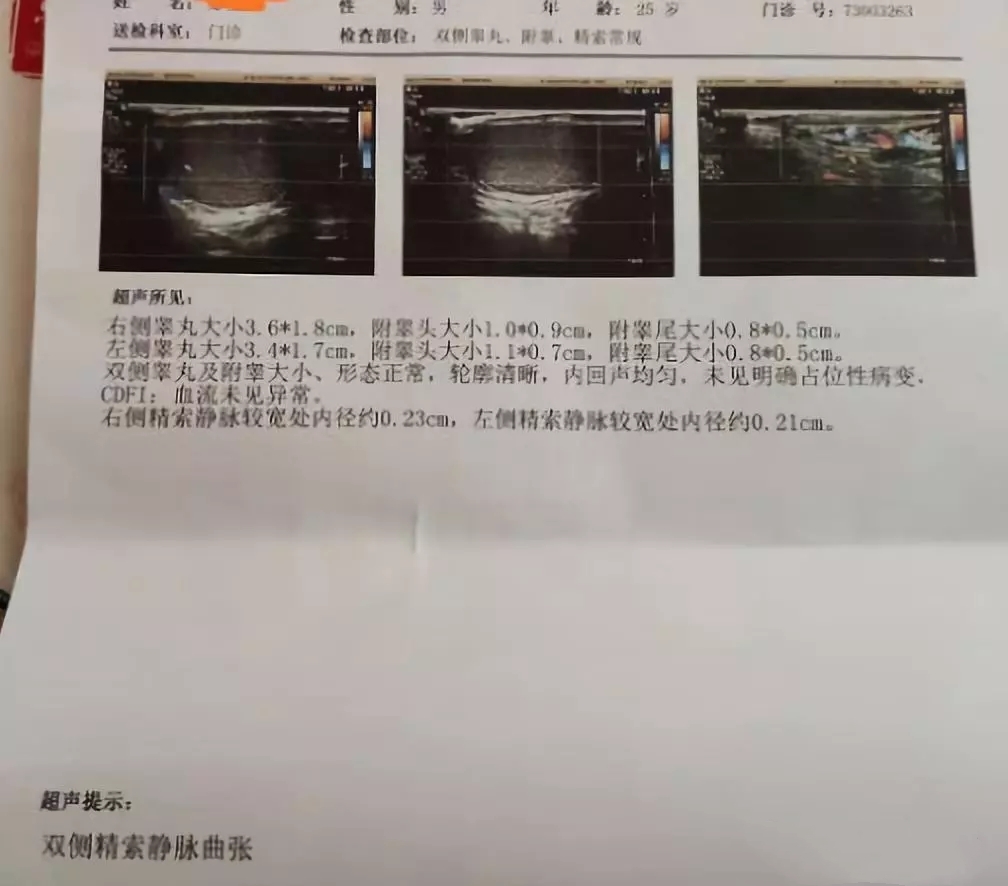 得了精索静脉曲张会怎么样