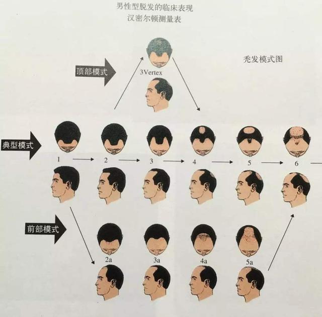 怎么判断是不是脂溢性脱发