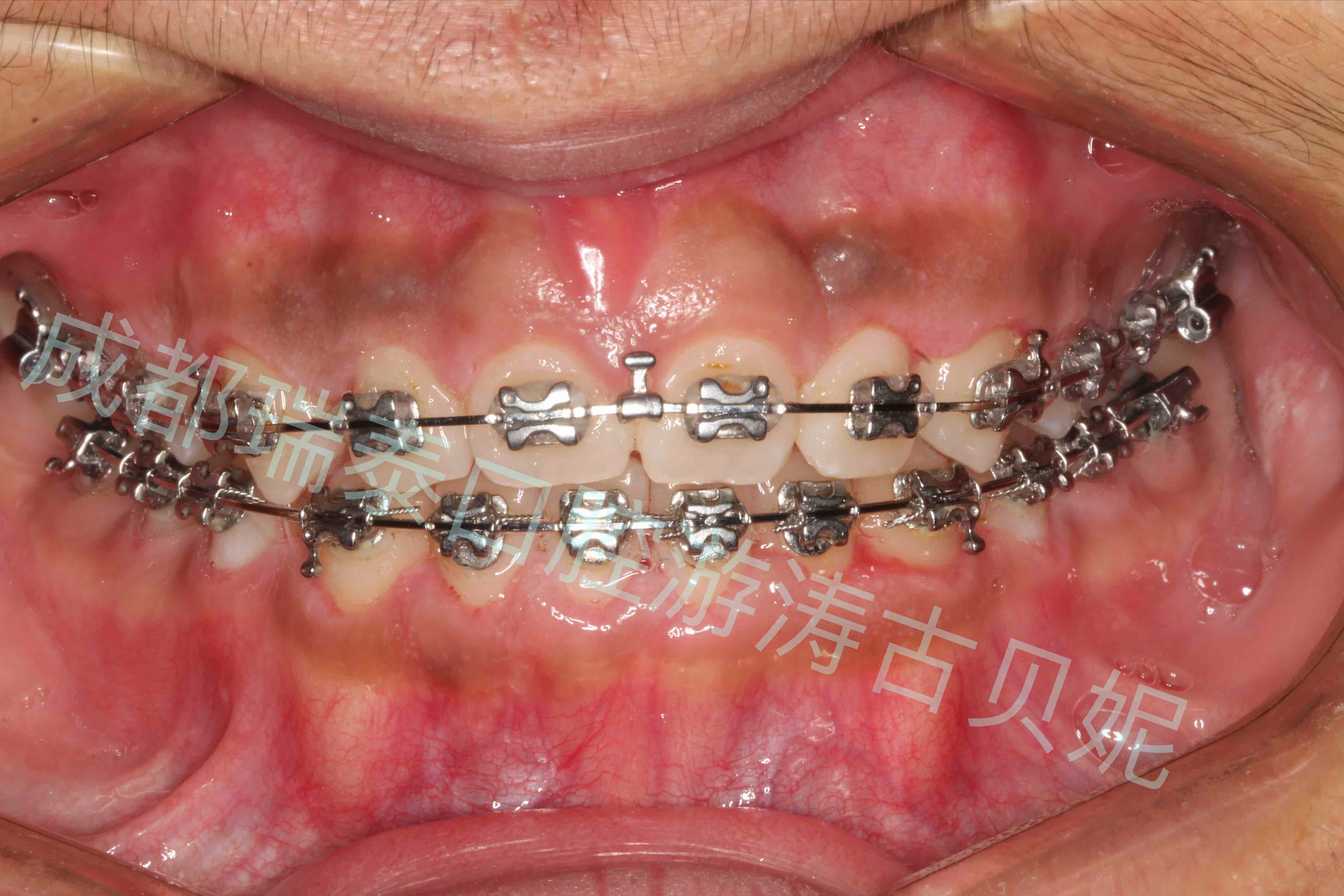 我们来看一例因为牙龈增生严重影响治疗进程,必须做牙龈切除术患者的