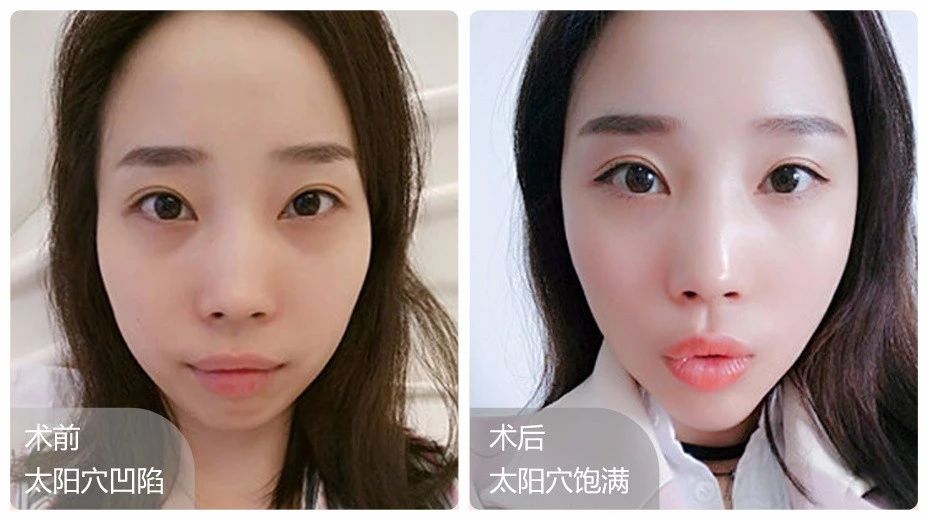 鼻子可是功不可没 很多亚洲人鼻梁都比较扁平 用玻尿酸填充,轻松帮你