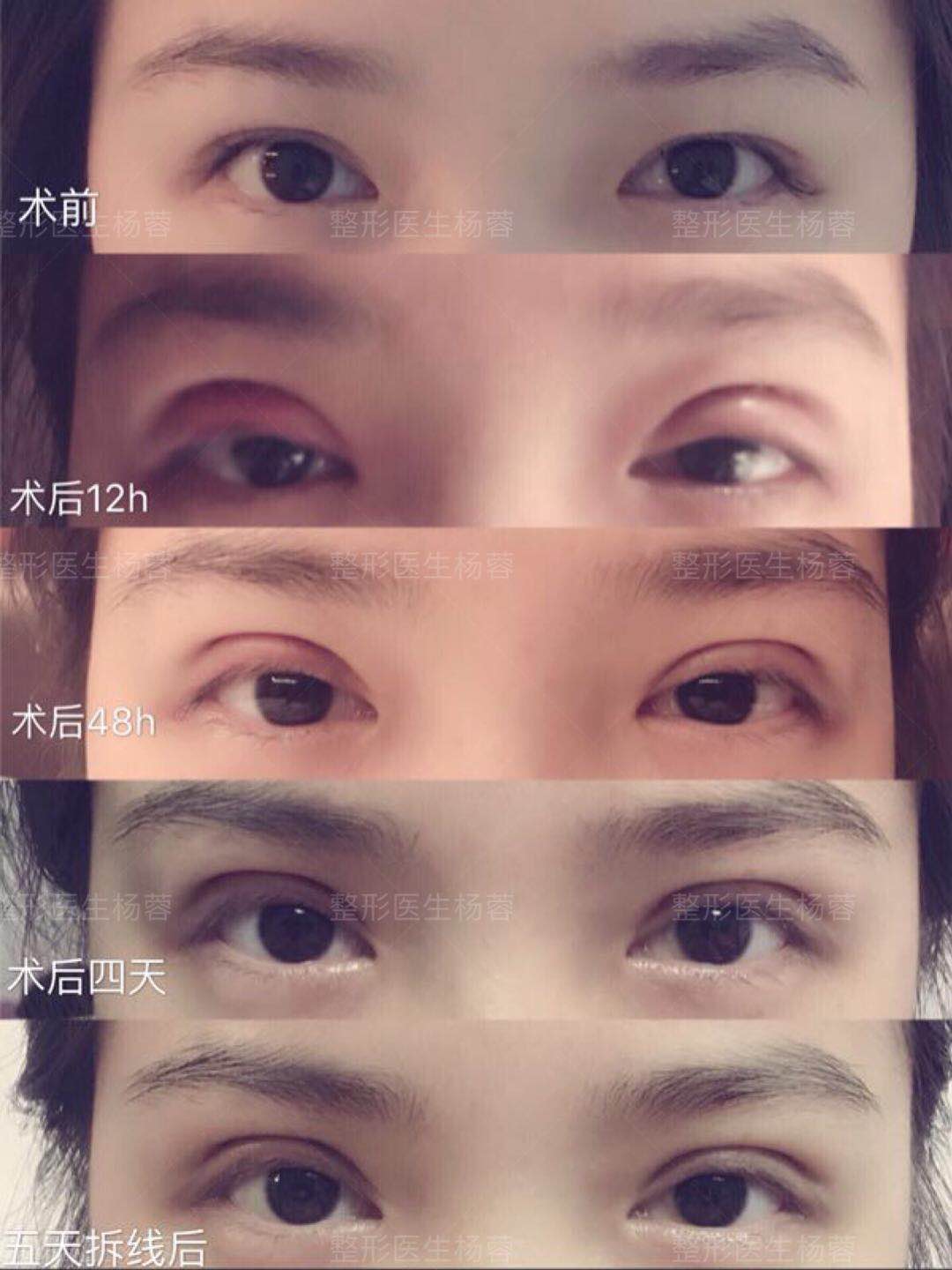给自己点耐心:双眼皮术后一定要有一段恢复期!