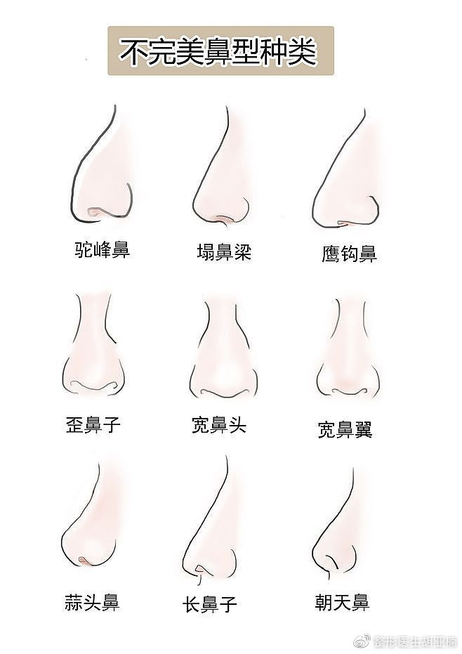 6)小尖鼻:鼻型瘦长,鼻尖单薄,鼻翼紧附鼻尖,展开度不大.