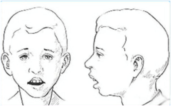 会破坏口腔内外肌力的平衡,导致颌骨发育异常,上颌骨变长,硬腭高拱,牙