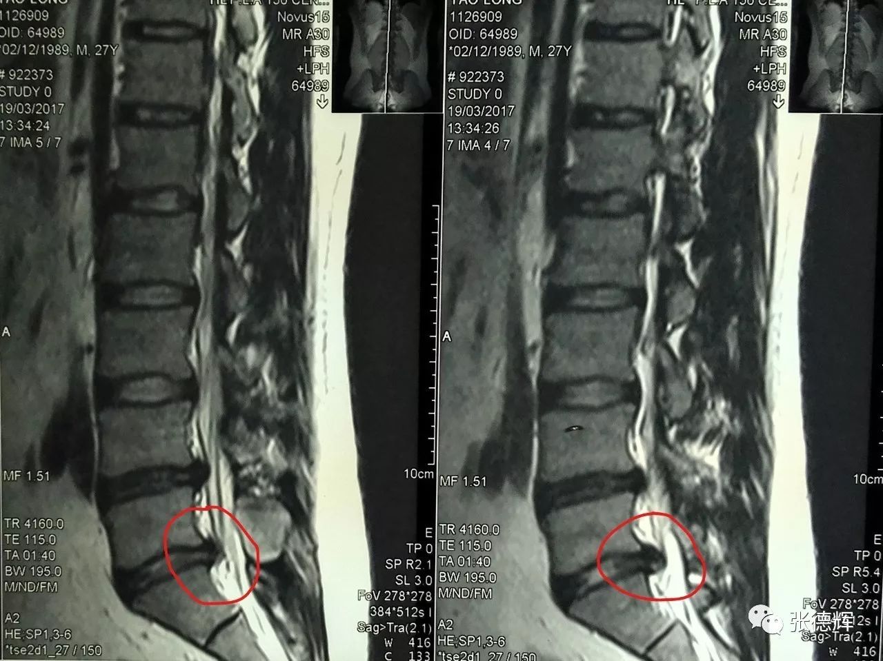 拇趾背伸肌力正常  他的影像学检查提示:腰4-5,腰5-骶1均有椎间盘突出