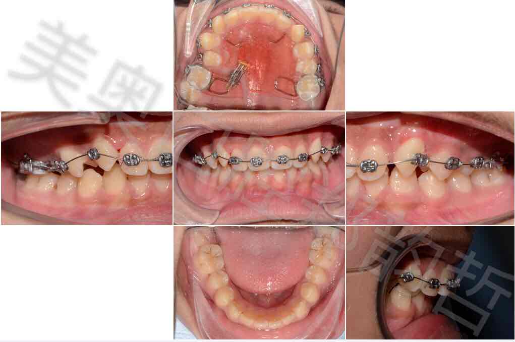 正畸案例(12岁,男-郑韵哲执业医师-爱问医生