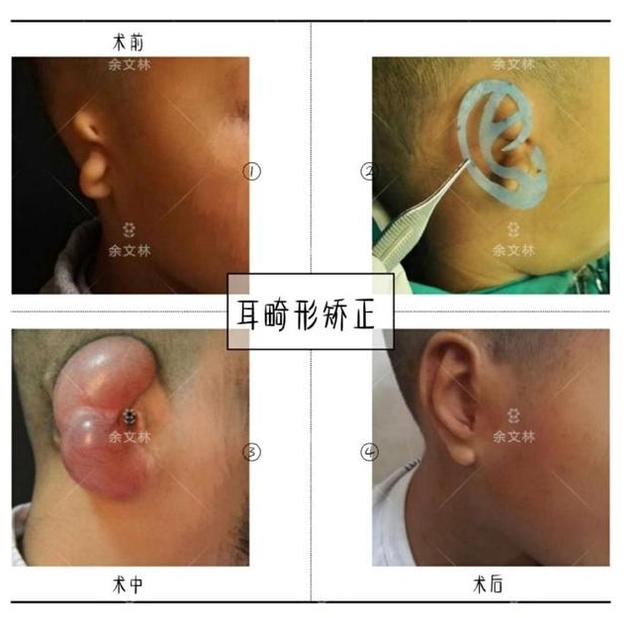 肋软骨?人工材料?小耳畸形患者该如何选择耳再造支架