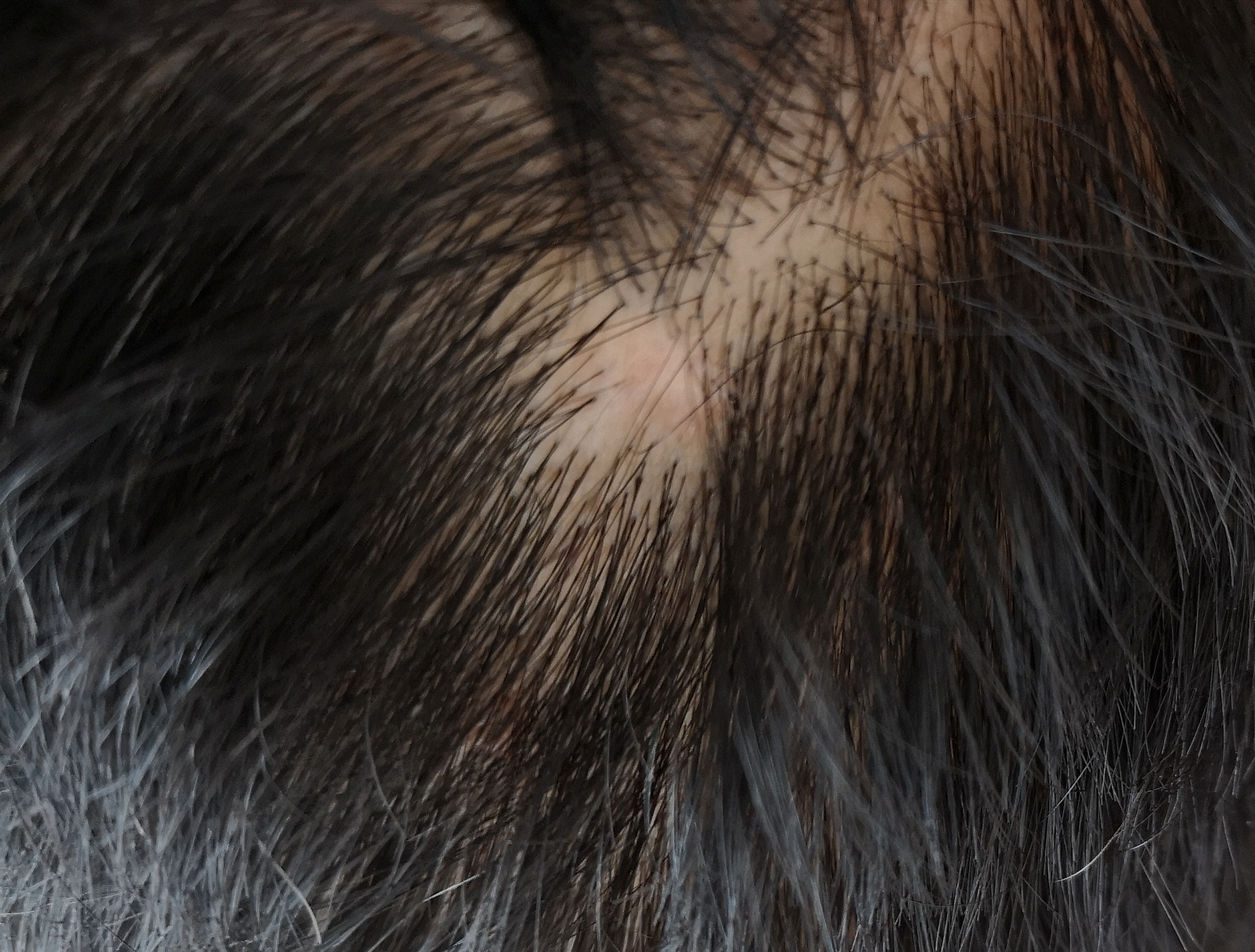 脱发也可以是感染所致,比如真菌感染所致的 头癣,或 梅毒性脱发