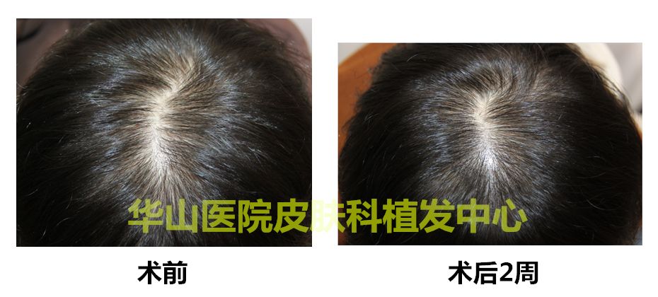 smp头皮纹发你了解多少