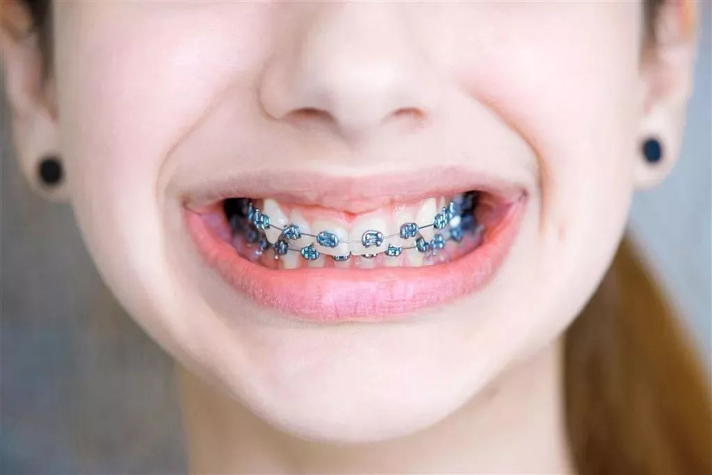 不管你有没有小孩,儿童牙齿矫正问题你都应该了解!