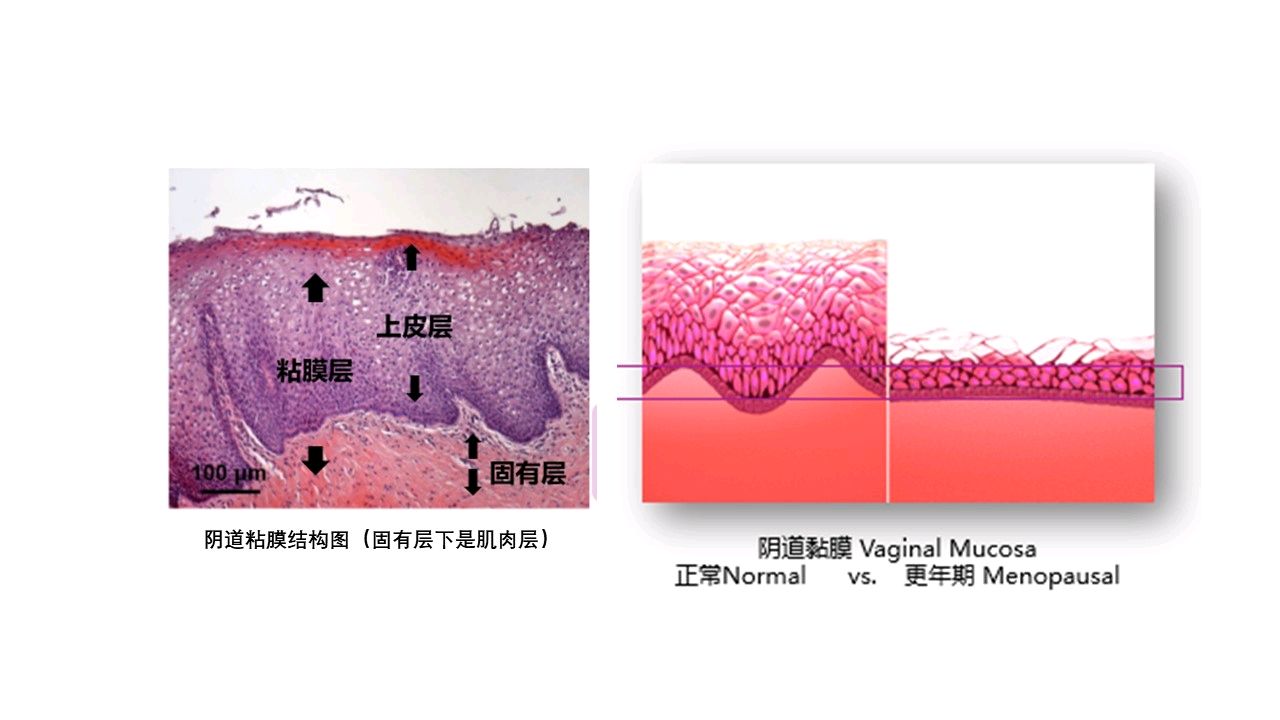 1, 重塑阴道固有层胶原蛋白,新胶原蛋白沉积,阴道粘膜上皮增厚,而不