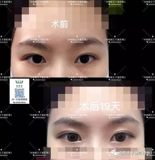 潘贰博士初眼案例 天生那么好看的双眼皮为什么还要做呢?