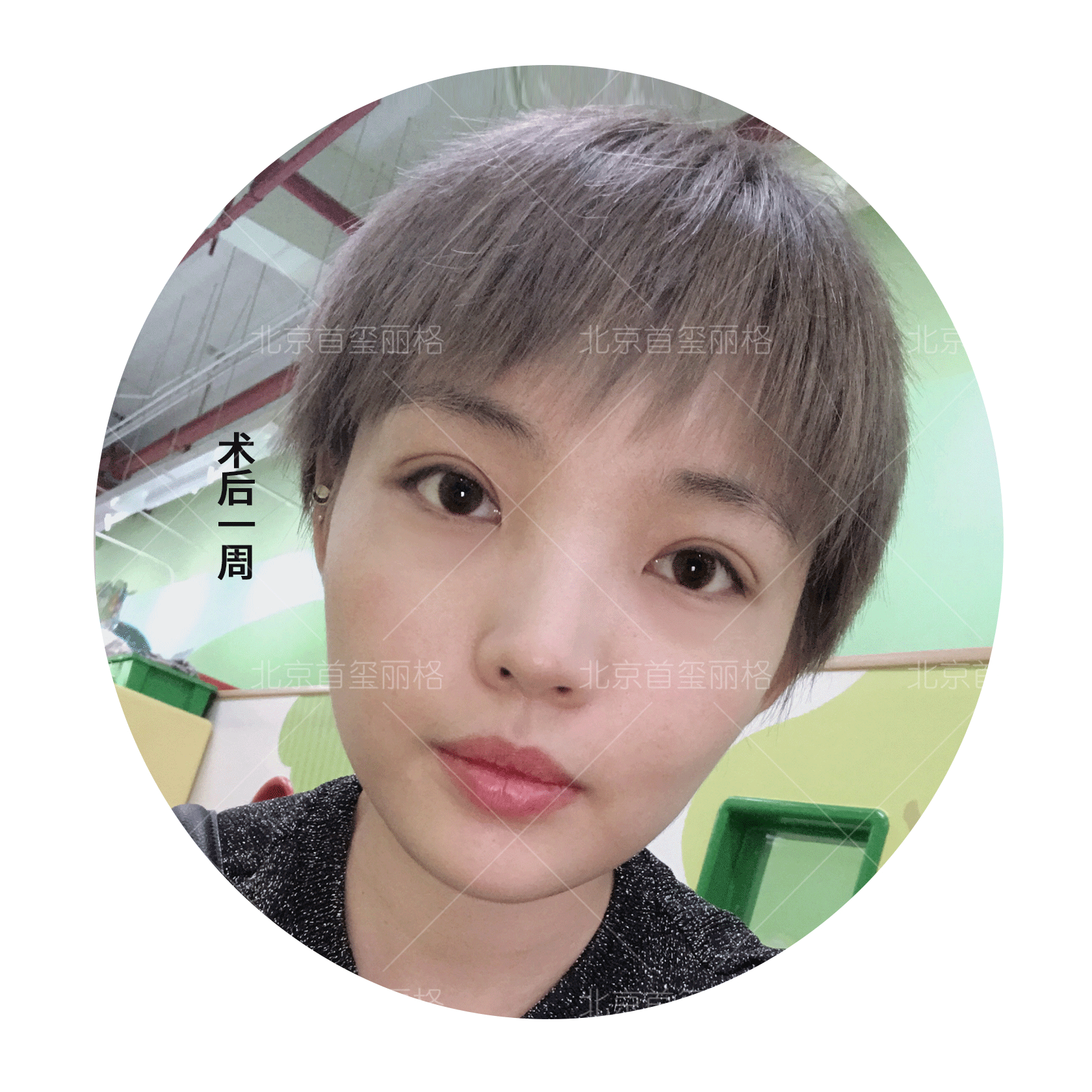 术后两周,双眼皮消肿了不少,睁眼闭眼痕迹也明显减轻,恢复得越来越好.